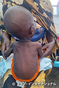 写真：深刻な栄養不良状態にある避難民の子ども（ご家族の同意を得て撮影）