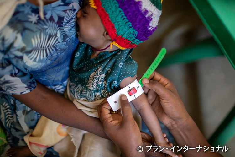写真：栄養状態の検査を受ける子ども（エチオピア）